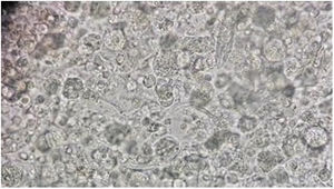 Visualización bajo microscopio de parásito (Lophomona spp.). Nótese la dificultad para ser diferenciado del tejido bronquial normal. Localizado dentro del círculo.