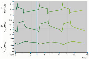 Gráfica de sincronía paciente ventilador. a: Presión esofágica/tiempo: línea azul representa el inicio de la contracción diafragmática, lo que se traduce en la presencia de una inflexión negativa; b: Presión/tiempo: el inicio de la contracción diafragmática genera un cambio en las presiones de la vía aérea, generando aumento de estas; c: Flujo/tiempo: la contracción diafragmática, con consecuente cambio de presiones en vía aérea, conlleva a apertura de válvula inspiratorio y movilización de volumen, que se representa en esta gráfica como ascenso del flujo durante inspiración. Paw: presión de las vías respiratorias; Pes: presión esofágica; línea azul: inicio de la inspiración neural; línea roja: el inicio de la inspiración del ventilador.