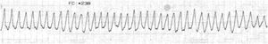 Trazado electrocardiográfico: registra taquicardia ventricular polimórfica.