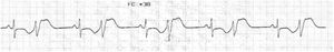 Trazado electrocardiográfico: registrando bigeminismo y extrasístoles ventriculares durante la repolarización ventricular, con alto riesgo de arritmia por pospotenciales.