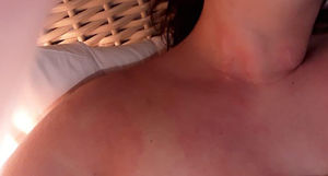 Placas eritematosas que comprometen el cuello y el tórax. Fotos publicadas con autorización de la paciente.