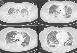 TAC-AR de tórax en el parénquima pulmonar. Se identifica vidrio esmerilado de predominio en los lóbulos superiores en donde hay consolidaciones, engrosamiento liso de septos interlobulillares.