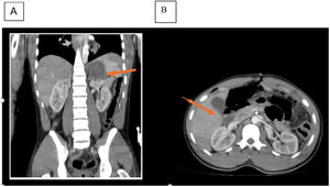 Tomografía computarizada de abdomen A) corte coronal y B) corte axial en la flecha se visualiza pequeño hematoma subcapsular esplénico y distensión del marco cólico.