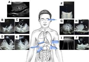 Principales hallazgos ecográficos en el paciente con dengue. A) Índice de vena cava. B) Derrame pericárdico. C) Función ventricular. D y E) Engrosamiento de la pared de la vesícula biliar y edema perivesicular. F) Nervio óptico. G) Hepatomegalia. H) Derrame pleural. I) Edema pulmonar. J) Ascitis.