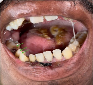 Cavidad oral del paciente. Lesiones dentales señaladas con flechas verdes. Fuente: propia, reproducido con autorización del paciente.