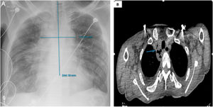 Imágenes torácicas del paciente. (A) Radiografía de tórax anteroposterior; mediastino ensanchado. (B) Tomografía axial computarizada simple de tórax: evidencia de neumomediastino (flecha azul).