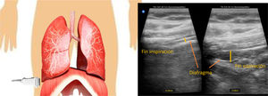 Evaluación del engrosamiento diafragmático. Imágenes obtenidas en modo B. A) Al final de la inspiración (máximo engrosamiento). B) Al final de espiración (mínimo engrosamiento).