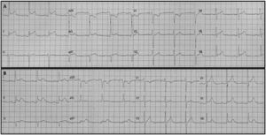 A) Electrocardiograma al ingreso a la unidad de cuidado intensivo: se destaca la elevación de ST sobre las derivaciones I, II, aVF, V5 y V6 asociada a cambios en espejo en aVR, considerándose sugestivo de compromiso de arteria circunfleja con compromiso de la pared en lateral. B) Electrocardiograma control a las 48 horas: persistencia de alteración de ST en I, II, V4, aVF, V5, V6 y cambios en espejo.