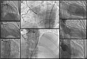 Coronariografía y ventriculograma. A) Coronaria izquierda con evidencia de flujo TIMI: 3, sin evidencia de lesiones clínicamente significativas. B) Coronaria derecha, sin evidencia de lesiones significativas. C superior: ventriculograma en fin de diástole. C medio: ventriculograma en fin de sístole posterior a la infusión de medio de contraste, con evidencia de reflujo severo. C inferior: reflujo de contraste moderado posterior a la aortografía.