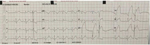 Electrocardiograma de ingreso a emergencias. Muestra elevación del segmento ST (4-5mm) en derivadas precordiales de V3 a V6 con ectopias ventriculares aisladas.