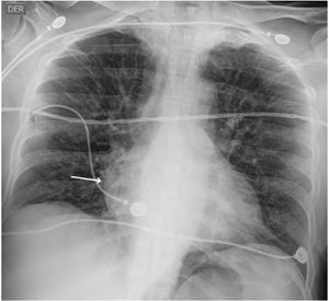 Radiografía de tórax de ingreso a emergencias. Impresiona dilatación auricular derecha, sin evidencia de derrame pleural ni redistribución de flujo.