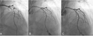 Arteriografía con cateterismo coronario izquierdo. Se evidencia lesión severa con disección en el tercio proximal de la arteria descendente anterior (A, flecha negra), con posterior canulación, angioplastia y stent medicado sobre la lesión con adecuado flujo distal (B y C).