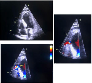 Ecocardiograma transtorácico. Muestra la rotura del septum interventricular de 8mm a nivel del tercio medio apical de la pared inferoseptal (flecha blanca) con leve cortocircuito desde el ventrículo izquierdo hacia el ventrículo derecho (flecha amarilla).