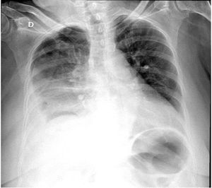 Radio lucidez sin broncograma aéreo y delimitación de la pleura visceral en el campo pulmonar derecho, sugiriendo neumotórax.