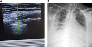 A) Imagen que muestra el signo del código de barras. B) Radiografía posquirúrgica con tubo de toracostomía, sin evidencia clara de neumotórax.