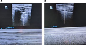 Secuencia ecográfica de la atención de reexpansión pulmonar día 2 (A) y día 3 (B) recuperación del movimiento pleural y signos de la arena y el mar, además puede visualizarse el pulso pulmonar.