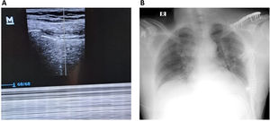 A) Imagen que muestra el signo del código de barras punto pulmonar. B) Radiografía posquirúrgica con tubo de toracostomía sistema STRACOS.