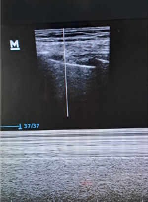 Recuperación del movimiento pleural y el signo de la arena y el mar.