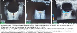 Medición de la vaina de mielina del nervio óptico (DVNO)68,69.