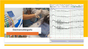 Electroencefalografía en paciente neurocrítico. Fuente: elaboración propia de los autores.