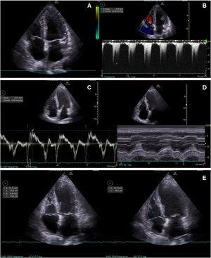 Mediciones ecocardiográficas de la función sistólica del VD: A) Apical 4 cámaras; B) Velocidad de ingurgitación tricuspídea; C) Ś(Doppler tisular del anillo tricúspideo en apical 4 cámaras; D) Excursión sistólica del anillo tricuspídeo (TAPSE, por sus siglas en inglés), y E) Cambio de área fraccional (CAF) del VD.