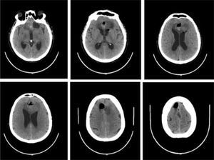 Tomografía axial de cráneo simple.