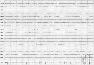 Electroencefalograma y videotelemetría.