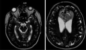 Resonancia magnética cerebral contrastadA.