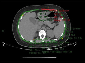 Medición tomográfica a nivel de T12. Delimitación de los grupos musculares: rectos (I), oblicuos (II), transversos (III), paraespinales (IV), en un rango de unidades Hounsfield de −29 a +150, que corresponden a la densidad muscular. El área muscular en centímetros se calculó automáticamente mediante la suma de los pixeles del tejido multiplicados por el área de la superficie de cada pixel.