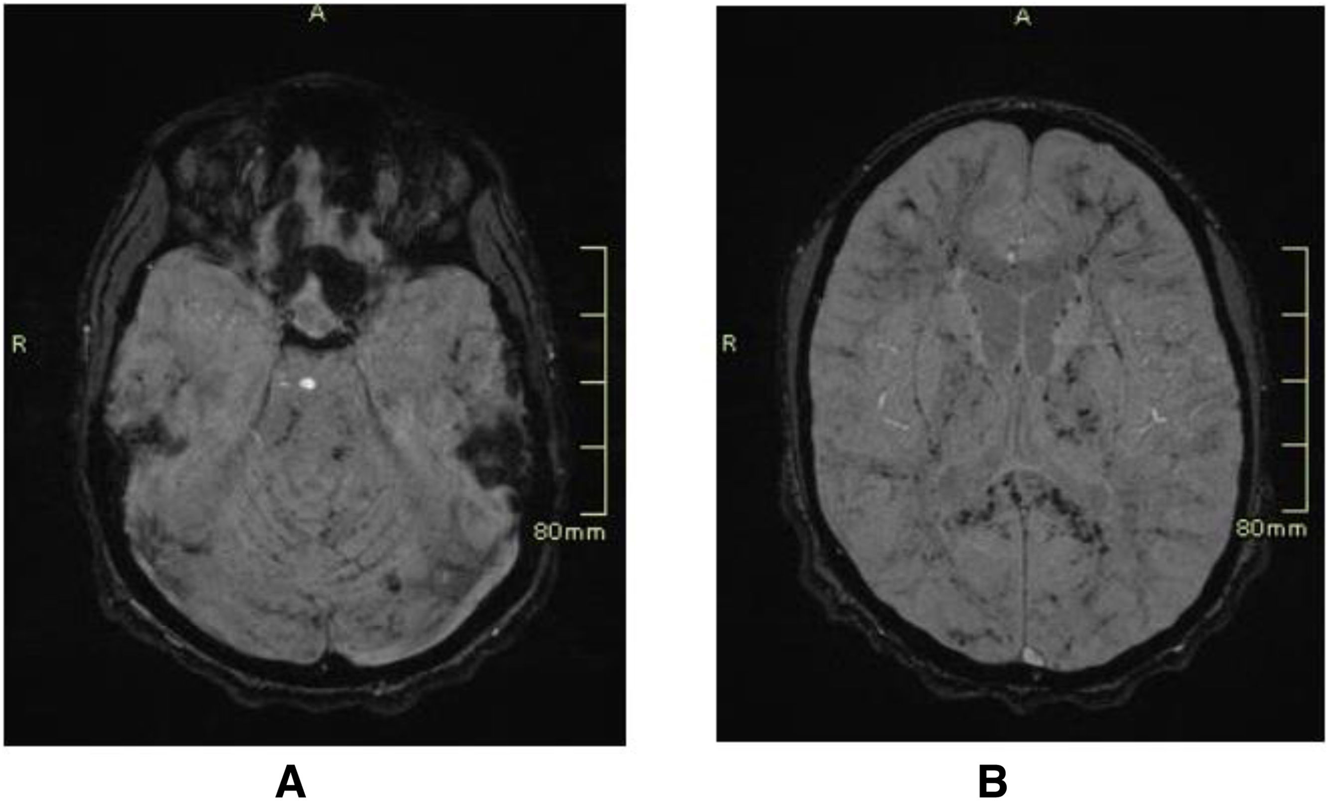 Daño axonal difuso posterior al trauma craneoencefálico en pediatría ...