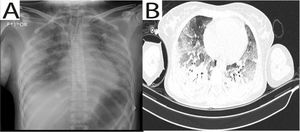 Hallazgos radiológicos representativos del SDRA asociado a infiltración de biopolímeros. (A) Radiografía de tórax portátil con infiltrados alveolares difusos que comprometen los 4 cuadrantes pulmonares. (B) Corte axial de tomografía de tórax con patrón de vidrio esmerilado bilateral y áreas de consolidación parcheada, compatibles con SDRA en fase exudativa.