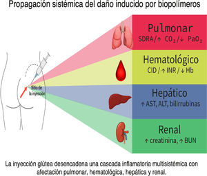 Representación esquemática del origen y diseminación sistémica del daño inducido por biopolímeros. Ilustración conceptual que muestra el sitio de inyección glútea como punto inicial de liberación de mediadores inflamatorios, con potencial afectación de los sistemas pulmonar, hepático, renal y hematológico. Resume de forma didáctica la relación entre la infiltración local y la respuesta inflamatoria sistémica observada en la paciente.