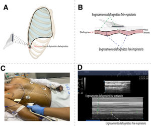 Anatomía, técnica de adquisición y medición ecográfica de la DTF. A) Zona de aposición; B) Grosor tele-espiratorio / tele-inspiratorio; C) Posicionamiento del transductor; D) Medición ecográfica en modo B/M.