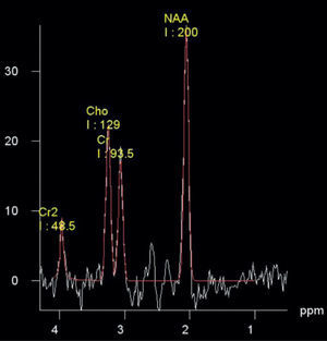 Espectro obtenido en los ganglios basales del lado izquierdo de uno de los voluntarios evaluados. Se muestra que la calidad de los espectros es aceptable, según el criterio clínico, en términos de la relación señal-ruido y del ancho de los picos.