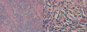 Tejido fibroso con formación de nódulos linfoides y numerosas estructuras vasculares con eosinofilia entremezclados. Aumento 10× y 40×.