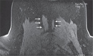 Imagen intraoperatoria de la reconstrucción endoprotésica del fémur distal.