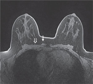 A y B. Radiografía postoperatoria de la endoprótesis de rodilla, con adecuada posición de los componentes.