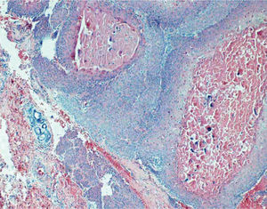 Tumor compuesto por células epiteliales que muestran áreas de queratinización triquilemal con zonas de proli feración epitelial y aspecto infi ltrativo en el estroma, mostrando atipia citológica.