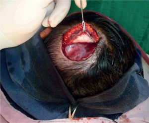 Resección del tumor con margen lateral de tejido sano de 1,5 centímetros, incluyendo en profundidad la fascia tem poral superfi cial.