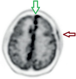 Reconstrucción con corrección de atenuación F18-FDG-PET/CT cerebral. Corte axial que evidencia compromiso infiltrativo hipermetabólico a nivel interhemis férico, con SUVmáx. 14. También se aprecia la captación correspondiente al sitio de biopsia frontal izquierda.