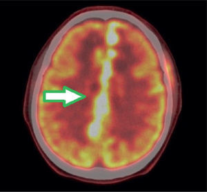 PET/CT imagen fusionada del cerebro. Corte axial que muestra el compromiso hipermetabólico antes descrito con su correcta localización anatómica en el TAC.