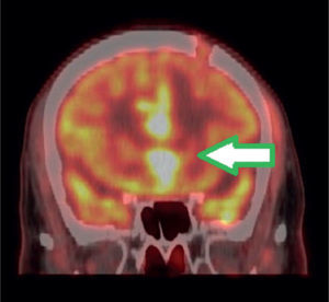 PET/CT imagen fusionada cerebral en vista coronal. Corte coronal evidenciando lesiones hiperglicolíticas que infiltran la región interhemisférica y cuerpo calloso; también se observa solución de continuidad frontal izquierda correspondien te a la biopsia.
