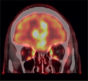 PET/CT imagen fusionada cerebral en un corte coronal más anterior. Se evidencian áreas nodulares hiperglicolíticas que comprometen región frontal interhemis férica.