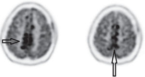 PET/CT imagen fusionada cerebral en un corte axial superior. Se observan las áreas nodulares hipermetabólicas que comprometen la falx cerebro; adicionalmente se observa captación correspondiente a la biopsia frontal izquierda.