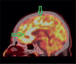 PET/CT imagen fusionada cerebral en un corte sagital. Se observa compromiso hipermetabólico multifocal cere bral más severo en la región frontal y cuerpo calloso (rodilla y cíngulo anterior).