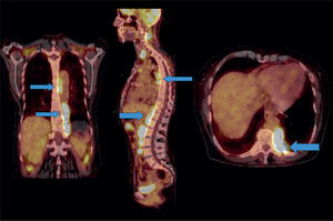 Cortes coronal, sagital y axial que muestran múltiples áreas de hipermetabolismo paravertebral y paraaórtico que sigue el eje simpático en tórax y abdomen (flechas azules).