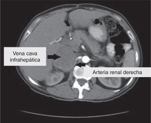 Tomografía axial computarizada de una paciente femenina de 56 años con diagnóstico de leiomiosarcoma retroperitoneal.