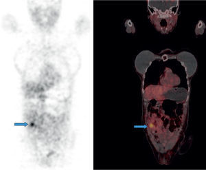 Corte coronal que evidencia compromiso infiltrativo por el tumor primario en asa ileal con sobreexpresión de receptores de somatostatina.