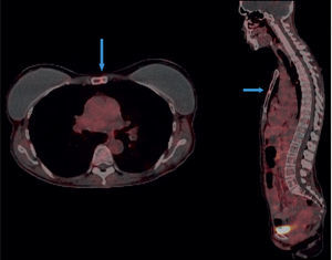 Cortes axial y sagital que muestran lesión focal osteoblástica metastásica con sobreexpresión de receptores de somatostatina en el cuerpo del esternón (flechas azules).