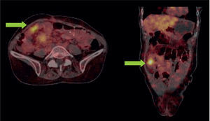 Se evidencia lesión primaria con sobreexpresión de receptores de somatostatina en el íleon con estrechez en el asa intestinal (flechas verdes).